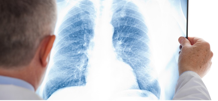 Akciğer Kanseri Farkındalık Ayı